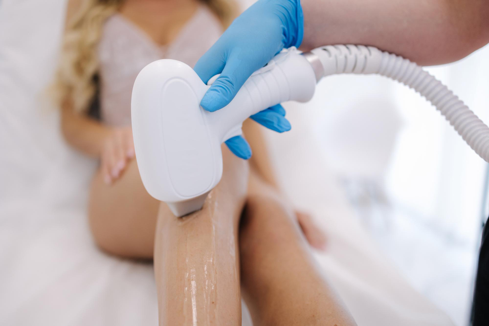 lasersko odstranjevanje dlak na nogah